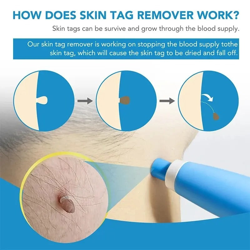 Skin Tag Removal Kit Blue Handheld At Home Fall 2025 - Tophatter Daily Deals