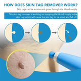 Skin Tag Removal Kit Blue Handheld At Home Fall 2025 - Tophatter Daily Deals