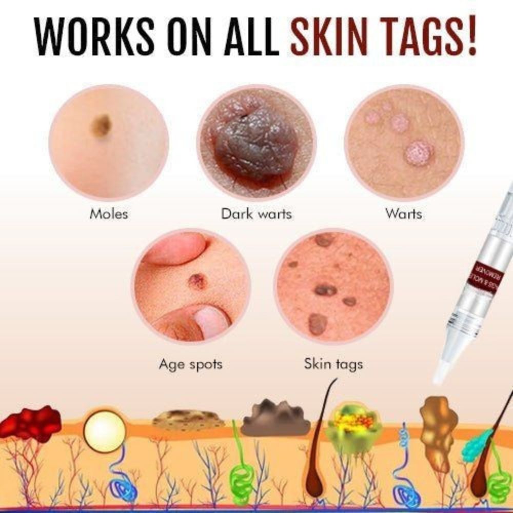 Skin Tag Mole Remover Pen With Tea Tree Oil Fast Home - Tophatter Daily Deals