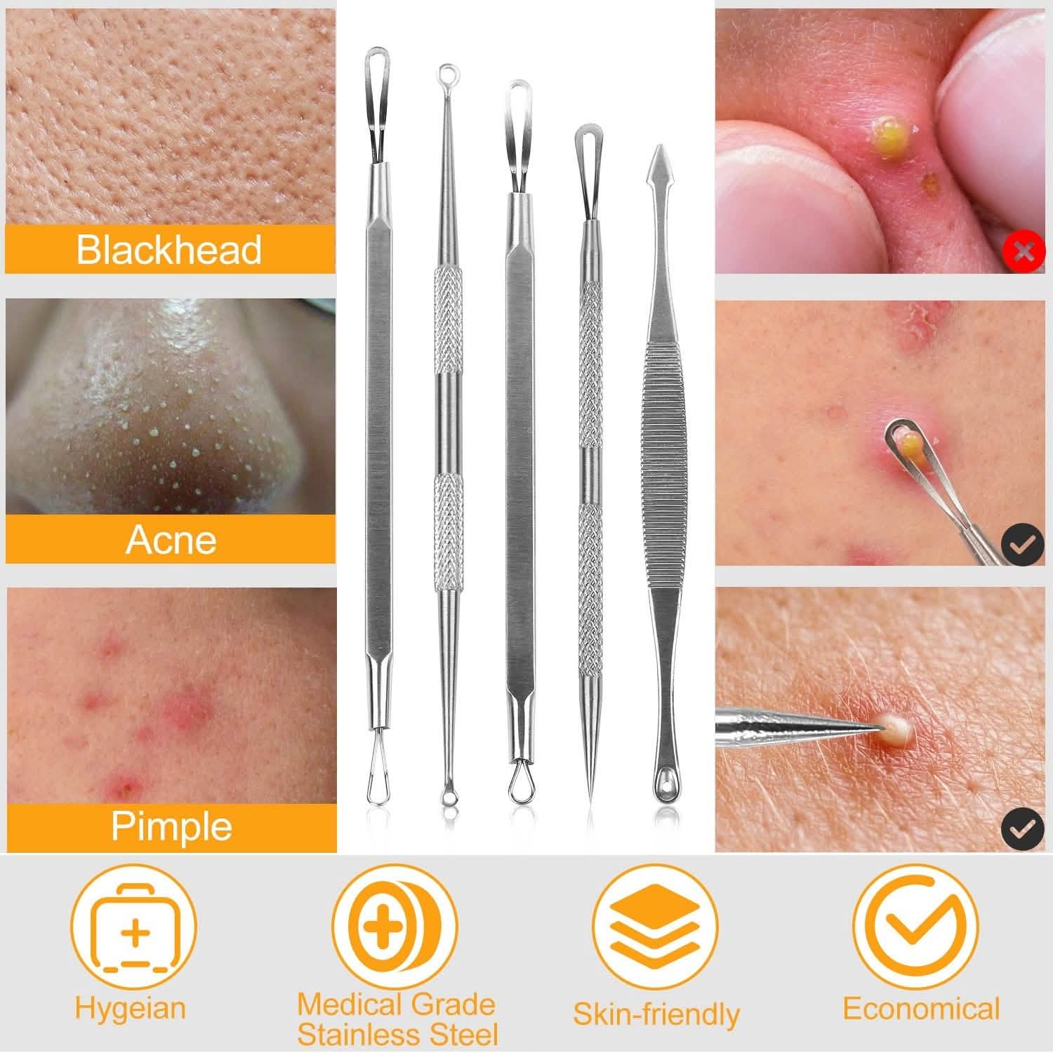 5-Piece Set: Blackhead Remover Kit Stainless Steel Popping Zit Remover Beauty & Personal Care - Tophatter Daily Deals