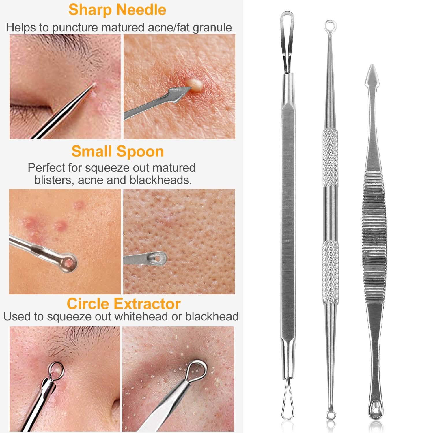 5-Piece Set: Blackhead Remover Kit Stainless Steel Popping Zit Remover Beauty & Personal Care - Tophatter Daily Deals