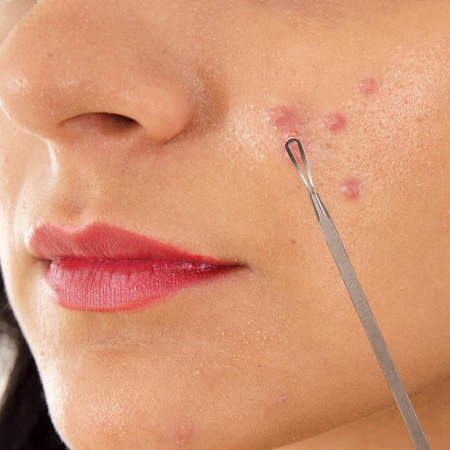 7-Pieces: Blackhead Remover Stainless Steel Beauty & Personal Care - Tophatter Daily Deals