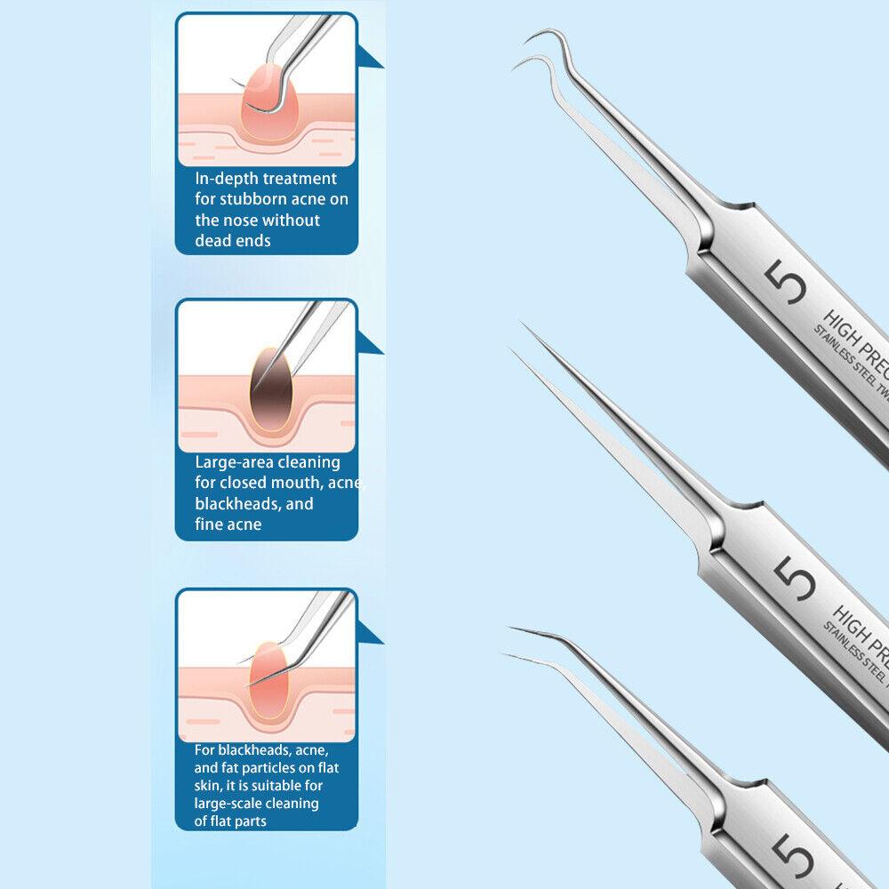 Blackhead Remover Needle - Acne Needle Kit Blackhead Remover Pimple Blemish Comedone Extractor Tweezer Tool Health & Beauty - Tophatter Daily Deals