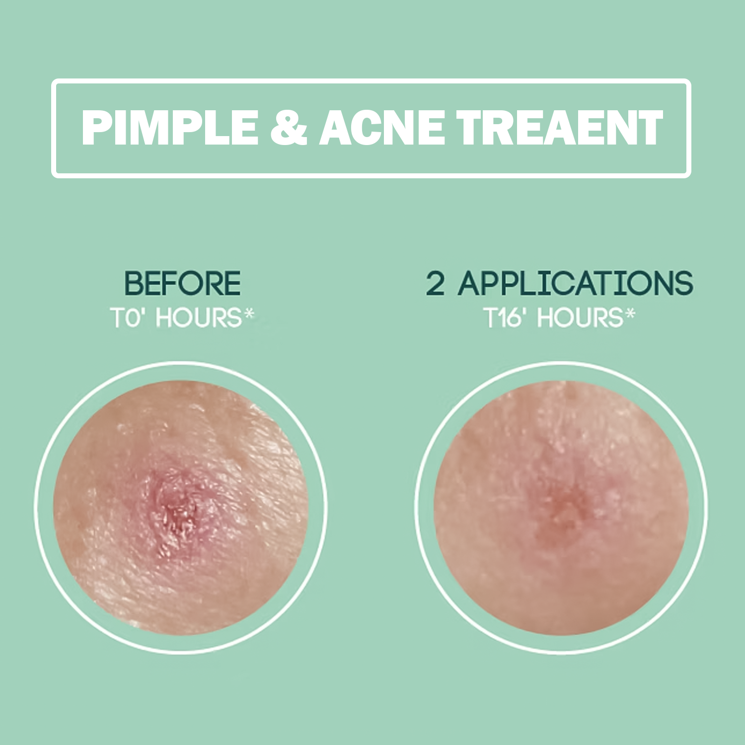 Hydrocolloid Pimple Patches – Dots for Spots Acne Patch | Pack of 24 Korean Skincare Spot Stickers Hydrocolloid pimple patches - Tophatter Daily Deals