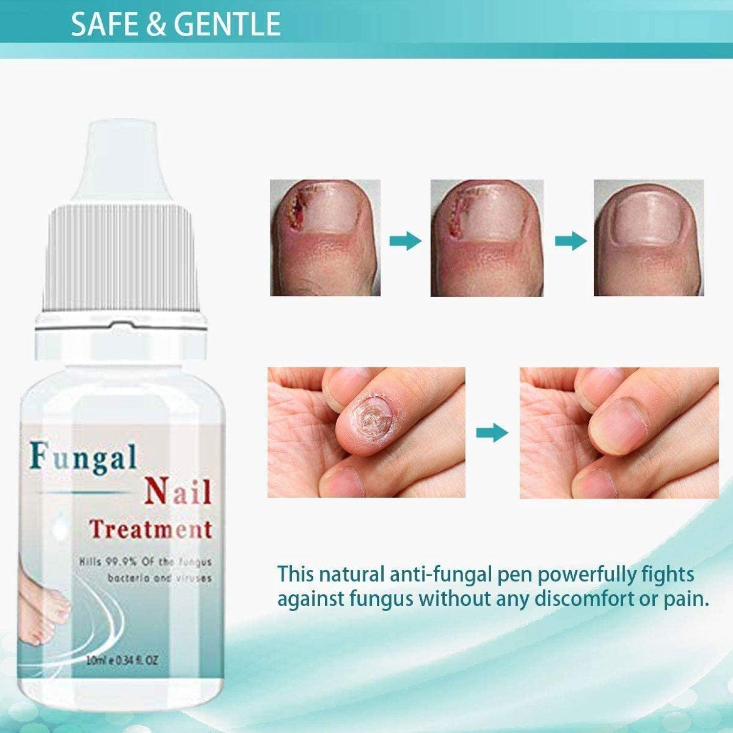 Fungal Nail Treatment - 10ml Liquid Highly Effective Kills Toenail Fungus Personal Care - Tophatter Daily Deals