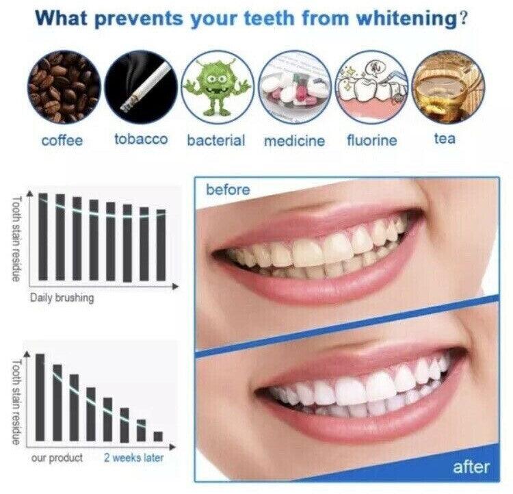 Teeth Whitening Strips - 28 Professional Advanced Teeth Whitening Strips Home Tooth Bleaching UK Non Toxic - Sensitivity Free Health Care - Tophatter Daily Deals