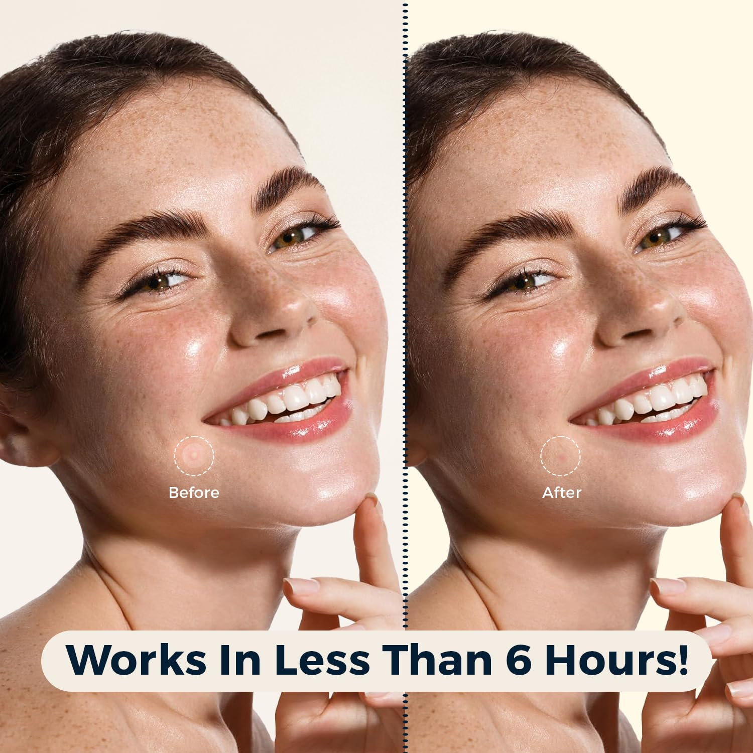 Clear Pimple Patch - 36pcs Sheet Acne Patch Tag Hydrocolloid Pimple Spot Acne Healing Dots Personal Care - Tophatter Daily Deals