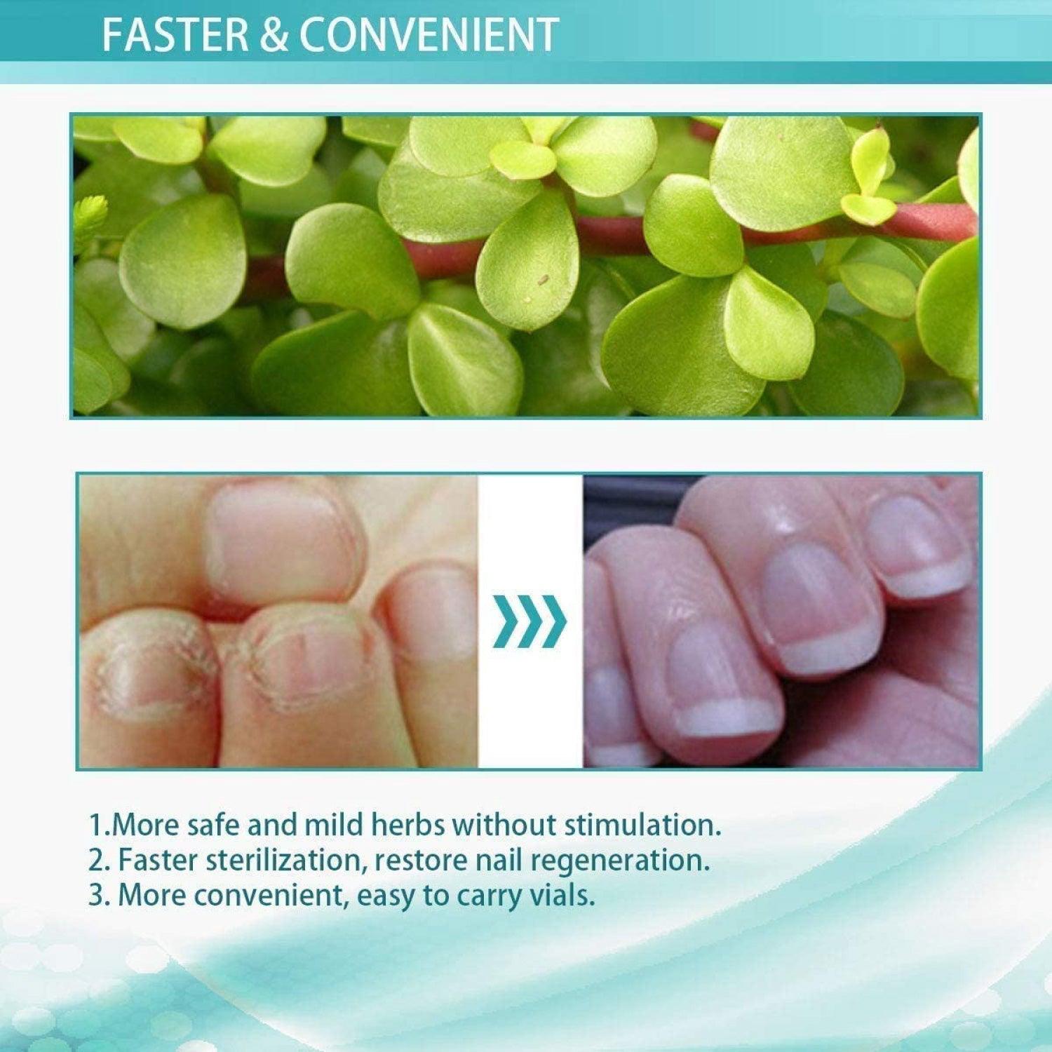 Fungal Nail Treatment - 10ml Liquid Highly Effective Kills Toenail Fungus Personal Care - Tophatter Daily Deals