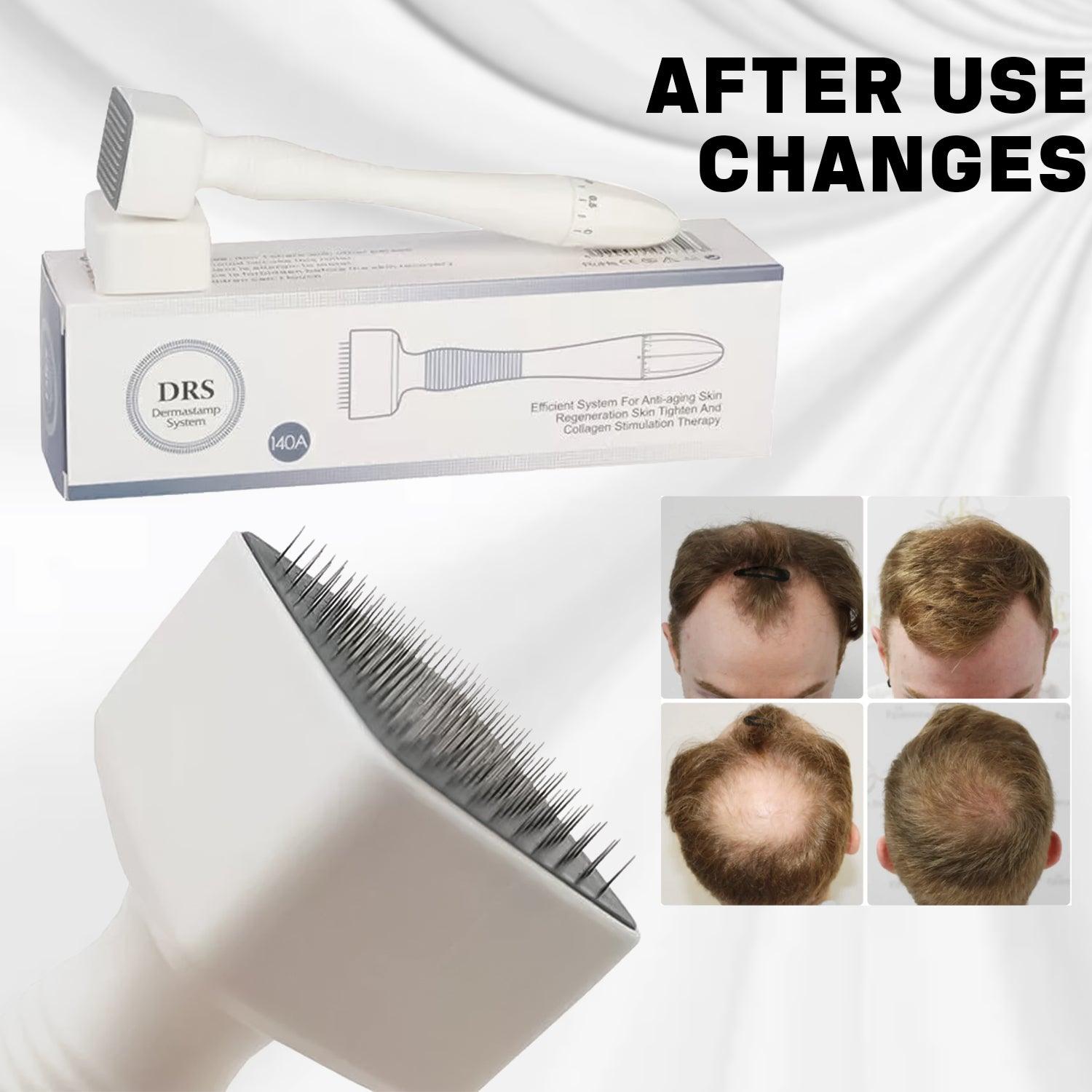 Derma Stamp Roller - Adjustable Roller 0-3mm Microneedle Anti Aging Therapy Face Health Care - Tophatter Daily Deals