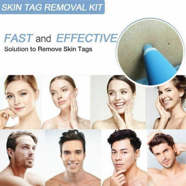Skin Tag Removal Kit - Natural Painless Auto SKIN TAG Removal Skin tag bands Remover Device Personal Care - Tophatter Daily Deals