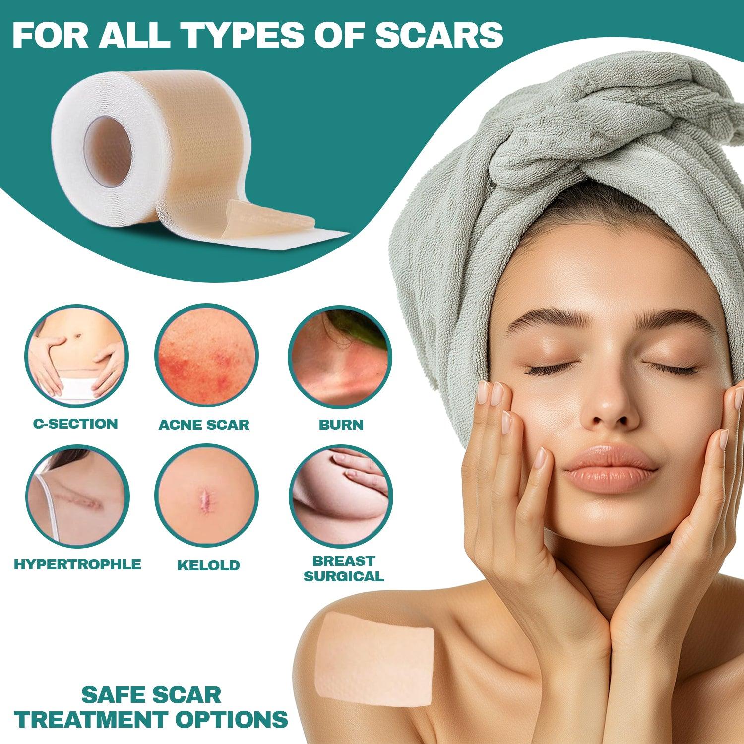 Silicone Scar Sheets - Medical Grade (1.6