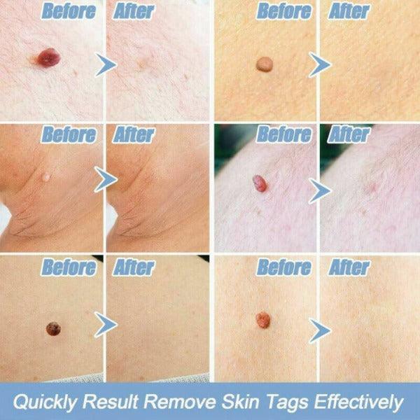 Skin Tag Removal Kit - Natural Painless Auto SKIN TAG Removal Skin tag bands Remover Device Personal Care - Tophatter Daily Deals