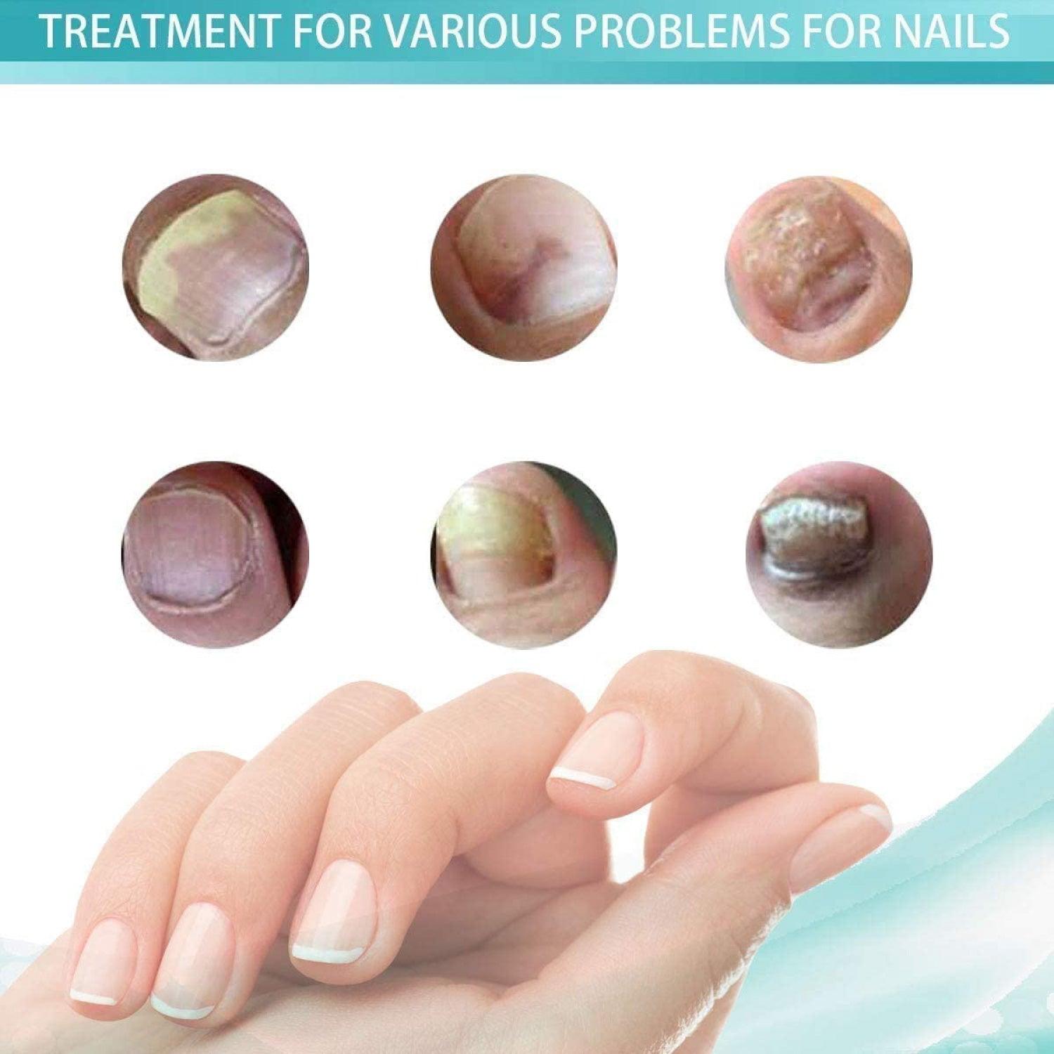 Fungal Nail Treatment - 10ml Liquid Highly Effective Kills Toenail Fungus Personal Care - Tophatter Daily Deals