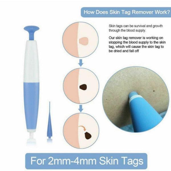 Skin Tag Removal Kit - Natural Painless Auto SKIN TAG Removal Skin tag bands Remover Device Personal Care - Tophatter Daily Deals