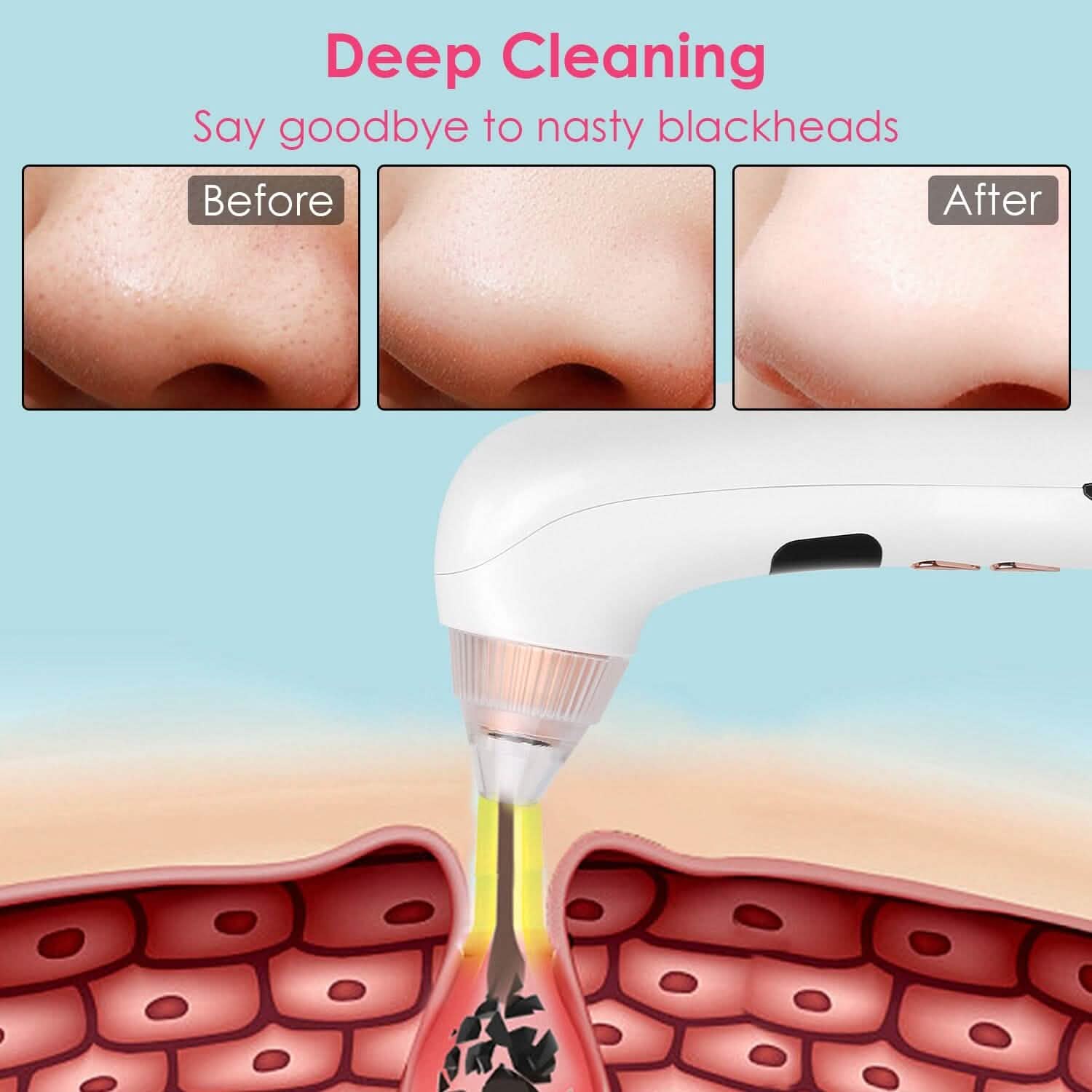Blackhead Vacuum Remover Electric Blackhead Comedone Extractor Beauty & Personal Care - Tophatter Daily Deals