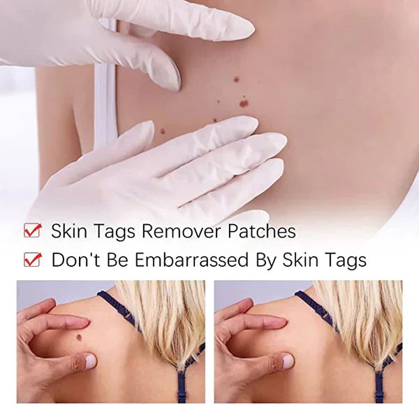 Skin Tag Mole Remover Pen With Tea Tree Oil Fast Home - Tophatter Daily Deals