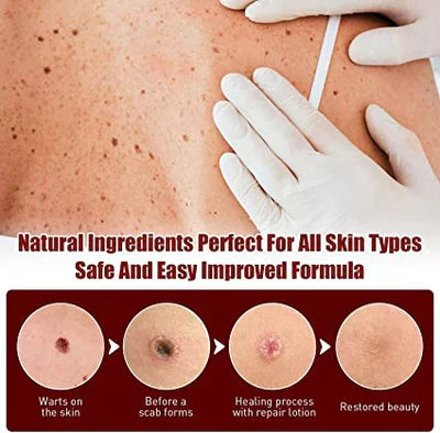 Skin Tag Mole Remover Pen With Tea Tree Oil Fast Home - Tophatter Daily Deals