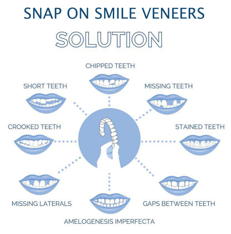 Smile Veneers Upper And Lower Instant Cover For All Day - Tophatter Daily Deals
