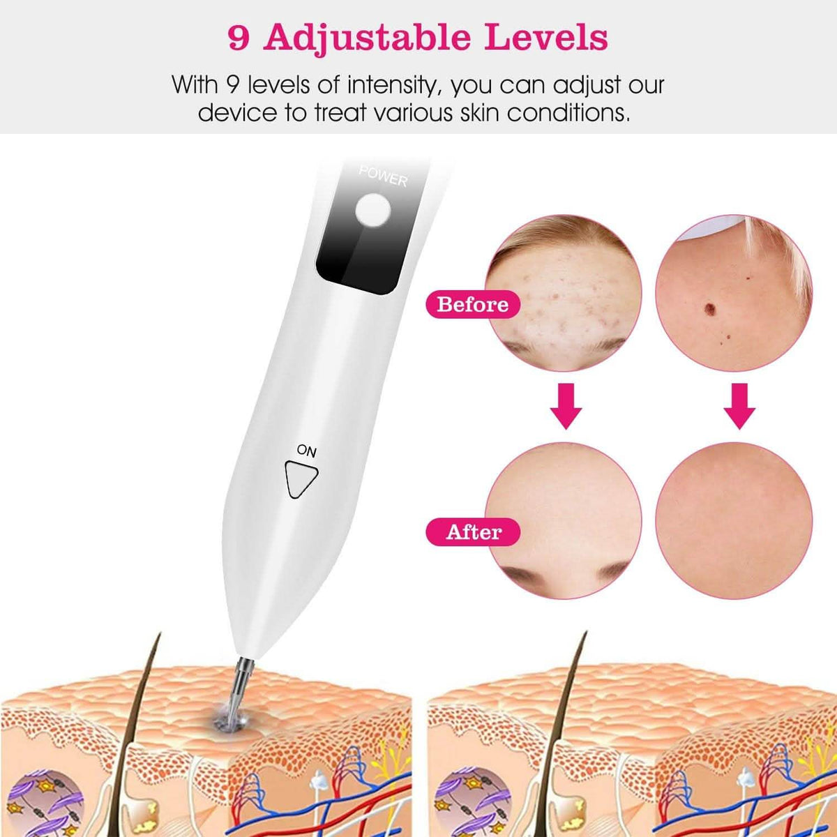Portable Skin Tag Repair Kit with 6 Replaceable Needles Beauty & Personal Care - Tophatter Daily Deals