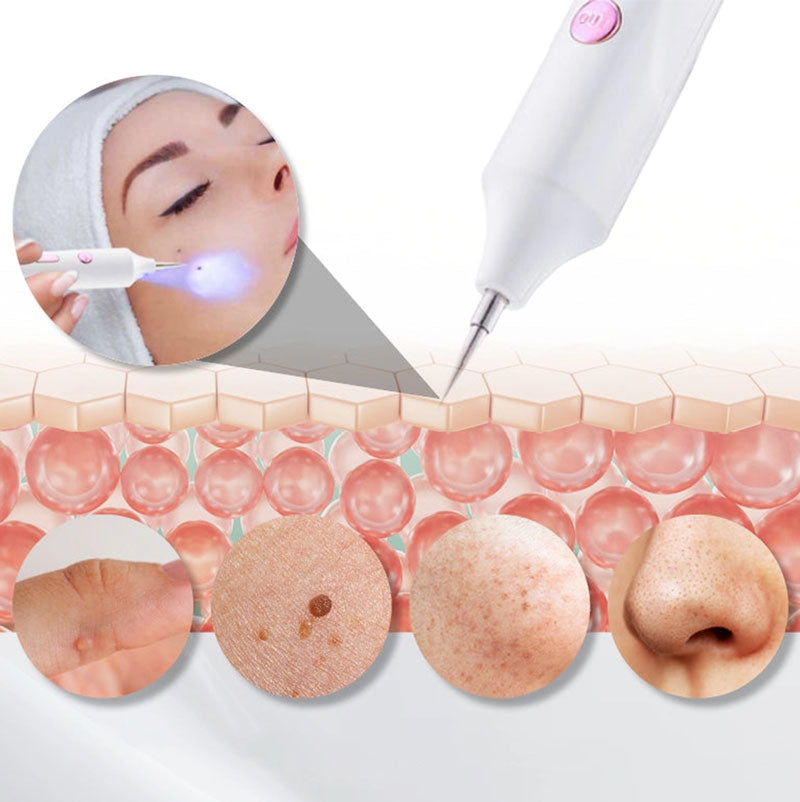 Mole Remover Pen Home Skin Tag Removal Painless Safe - Tophatter Daily Deals