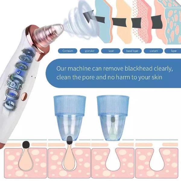 Best Blackhead Remover Vacuum - Professional Pore Cleaner Vacuum Blackhead Remover Rechargeable 5 Suction Levels Health & Beauty - Tophatter Daily Deals