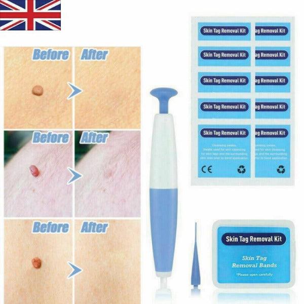 Skin Tag Removal Kit - Natural Painless Auto SKIN TAG Removal Skin tag bands Remover Device Personal Care - Tophatter Daily Deals